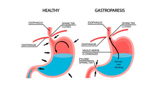 What is Gastroparesis: Symptoms, Causes, and Natural Food Remedies